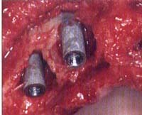 Impianti dentali Impianti dentali