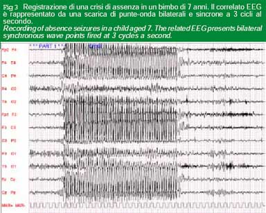 Figura 3 - Crisi epilettica bambino 7 anni