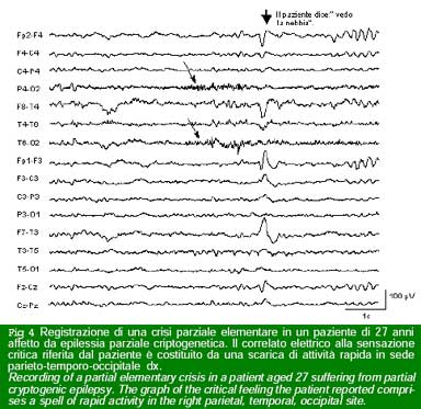 Figura 4 - crisi parziale epilettica paziente 27 anni