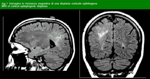 Figura 7 - immagine RMN cervello epilettogenico