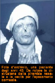 Figura Donna affetta da leprosi lebbra