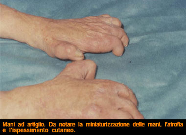Figura mani ad artiglio da leprosi