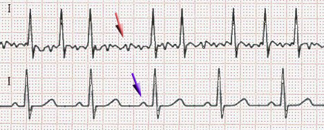 ECG di una fibrillazione attuale