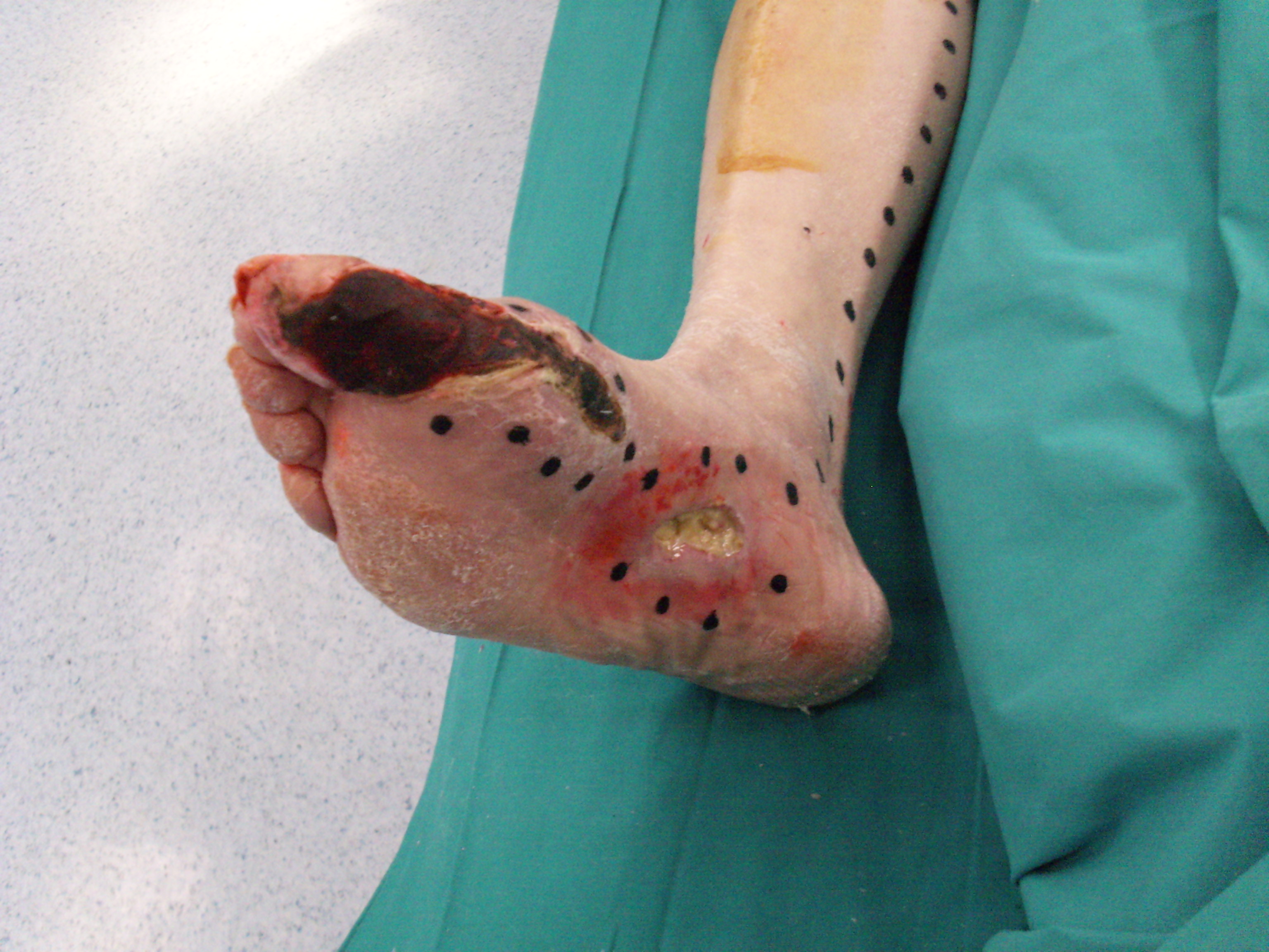 Figura 3: Mappaggio preoperatorio  dei siti di iniezione intramuscolo delle cellule staminali