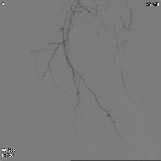Figura 5: Rx angiografia pre operatoria con scarsa rappresentazione dell’arcata plantare