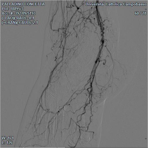 Figura 6: Rx angiografia dopo 6 mesi dall’impianto di cellule staminali: ricomparsa di una valida arcata plantare con i rami digitali