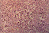 Carcinoma epatico figura 2