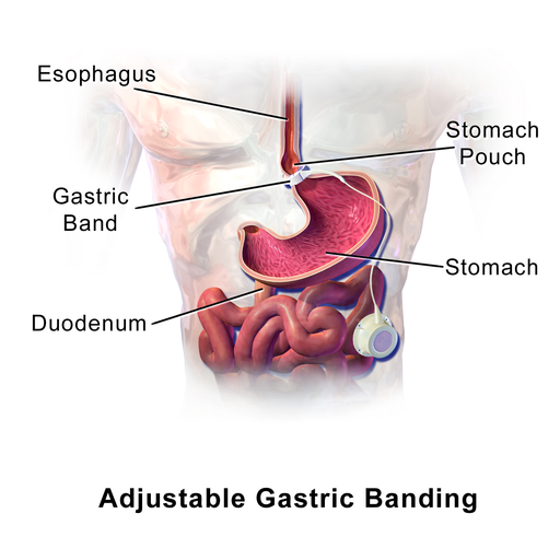 Figura 2. Bendaggio gastrico. Blausen.com staff (2014). “Medical gallery of Blausen Medical 2014”