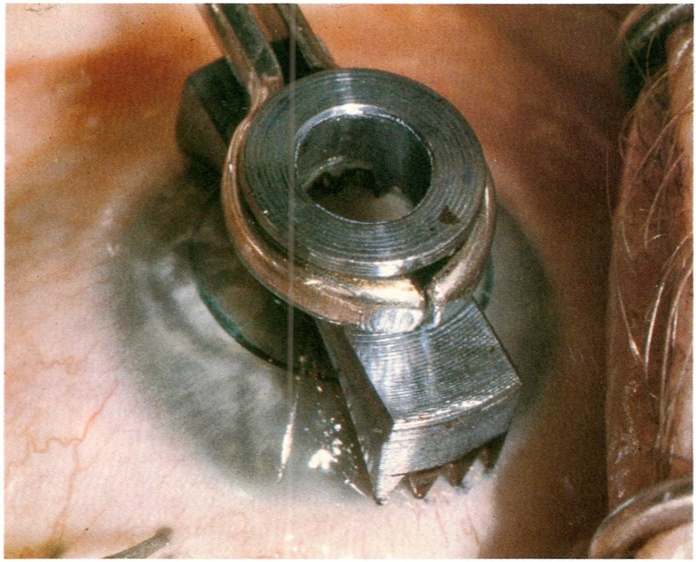 Con il marker si segnano sulla cornea le tracce per l'incisione