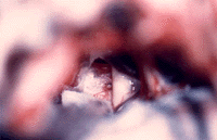 Nevralgia Trigemino 2