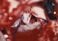 Nevralgia trigemino 9