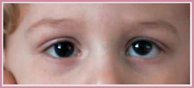 Fig. 1 - Ipertropia Fig. 1 - Ipertropia