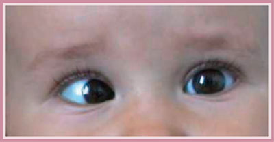 Fig. 2 - Riflessi corneali in esotropia Fig. 2 - Riflessi corneali in esotropia