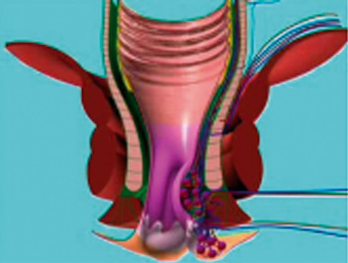 Figura 1 Fisiopatologia del prolasso mucoemorrodiario