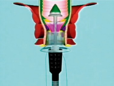 Figura 2 Introduzione della suturatrice meccanica PPH-03